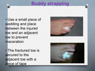 • Use a small piece of
wadding and place
between the injured
toe and an adjacent
toe to prevent
maceration
• The fractured toe is
secured to the
adjacent toe with a
piece of tape
Buddy strapping
 