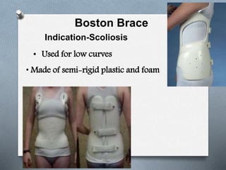Boston Brace
Indication-Scoliosis
• Used for low curves
• Made of semi-rigid plastic and foam
 