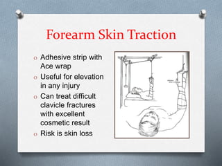 Forearm Skin Traction
O Adhesive strip with
Ace wrap
O Useful for elevation
in any injury
O Can treat difficult
clavicle fractures
with excellent
cosmetic result
O Risk is skin loss
 
