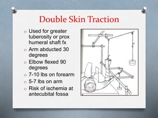 Double Skin Traction
O Used for greater
tuberosity or prox
humeral shaft fx
O Arm abducted 30
degrees
O Elbow flexed 90
degrees
O 7-10 lbs on forearm
O 5-7 lbs on arm
O Risk of ischemia at
antecubital fossa
 