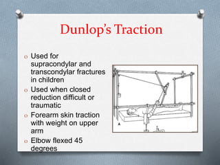 Dunlop’s Traction
O Used for
supracondylar and
transcondylar fractures
in children
O Used when closed
reduction difficult or
traumatic
O Forearm skin traction
with weight on upper
arm
O Elbow flexed 45
degrees
 