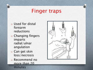 Finger traps
O Used for distal
forearm
reductions
O Changing fingers
imparts
radial/ulnar
angulation
O Can get skin
loss/necrosis
O Recommend no
more than 20
minutes
 
