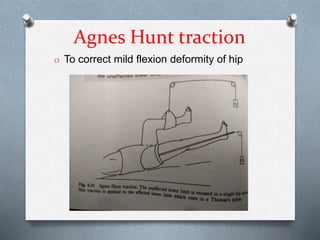 Agnes Hunt traction
O To correct mild flexion deformity of hip
 