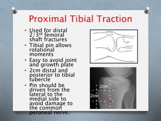 Proximal Tibial Traction
• Used for distal
2/3rd femoral
shaft fractures
• Tibial pin allows
rotational
moments
• Easy to avoid joint
and growth plate
• 2cm distal and
posterior to tibial
tubercle
• Pin should be
driven from the
lateral to the
medial side to
avoid damage to
the common
peroneal nerve.
 