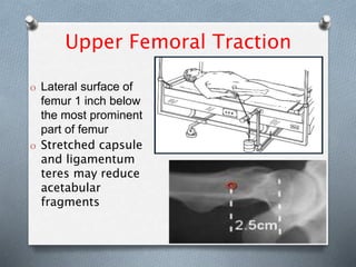 Upper Femoral Traction
O Lateral surface of
femur 1 inch below
the most prominent
part of femur
O Stretched capsule
and ligamentum
teres may reduce
acetabular
fragments
 