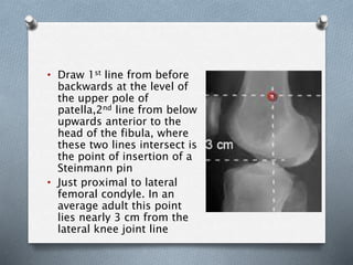 • Draw 1st line from before
backwards at the level of
the upper pole of
patella,2nd line from below
upwards anterior to the
head of the fibula, where
these two lines intersect is
the point of insertion of a
Steinmann pin
• Just proximal to lateral
femoral condyle. In an
average adult this point
lies nearly 3 cm from the
lateral knee joint line
 