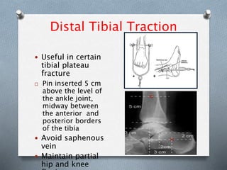 Distal Tibial Traction
 Useful in certain
tibial plateau
fracture
 Pin inserted 5 cm
above the level of
the ankle joint,
midway between
the anterior and
posterior borders
of the tibia
 Avoid saphenous
vein
 Maintain partial
hip and knee
 