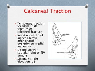 Calcaneal Traction
 Temporary traction
for tibial shaft
fracture or
calcaneal fracture
 Insert about 1 1/4
inches (3cms)
inferior and
posterior to medial
malleolus
 Do not skewer
subtalar joint or NV
bundle
 Maintain slight
elevation leg
 