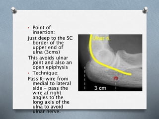 • Point of
insertion:
just deep to the SC
border of the
upper end of
ulna (3cms)
This avoids ulnar
joint and also an
open epiphysis
• Technique:
Pass K-wire from
medial to lateral
side - pass the
wire at right
angles to the
long axis of the
ulna to avoid
ulnar nerve.
 