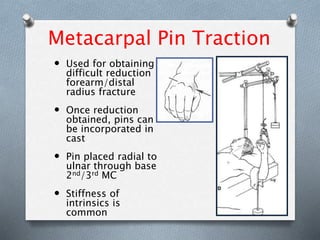 Metacarpal Pin Traction
 Used for obtaining
difficult reduction
forearm/distal
radius fracture
 Once reduction
obtained, pins can
be incorporated in
cast
 Pin placed radial to
ulnar through base
2nd/3rd MC
 Stiffness of
intrinsics is
common
 