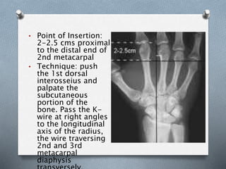 • Point of Insertion:
2-2.5 cms proximal
to the distal end of
2nd metacarpal
• Technique: push
the 1st dorsal
interosseius and
palpate the
subcutaneous
portion of the
bone. Pass the K-
wire at right angles
to the longitudinal
axis of the radius,
the wire traversing
2nd and 3rd
metacarpal
diaphysis
 