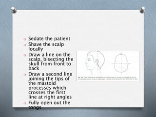 O Sedate the patient
O Shave the scalp
locally
O Draw a line on the
scalp, bisecting the
skull from front to
back
O Draw a second line
joining the tips of
the mastoid
processes which
crosses the first
line at right angles
O Fully open out the
tongs
 