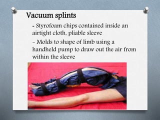 Vacuum splints
- Styrofoam chips contained inside an
airtight cloth, pliable sleeve
- Molds to shape of limb using a
handheld pump to draw out the air from
within the sleeve
 