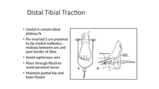 Distal Traction Rotation Comprehensive Overview of Traction Techniques in Orthopaedics for ...