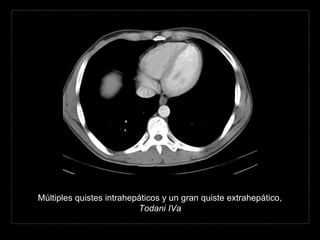 Múltiples quistes intrahepáticos y un gran quiste extrahepático,
Todani IVa
 
