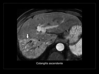 Colangitis ascendente
 