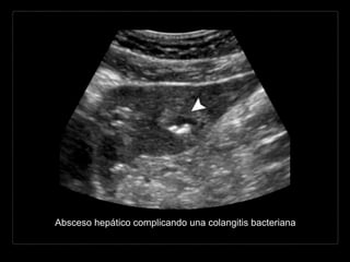 Absceso hepático complicando una colangitis bacteriana
 