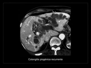 Colangitis piogénica recurrente
 