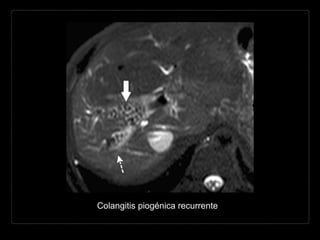 Colangitis piogénica recurrente
 