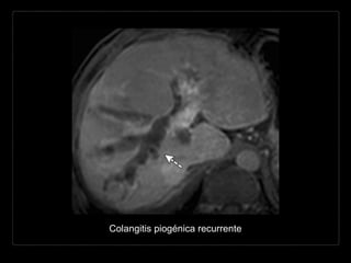 Colangitis piogénica recurrente
 