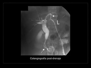 Colangiografía post-drenaje
 