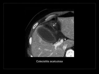 Colecistitis acalculosa
 