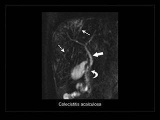Colecistitis acalculosa
 