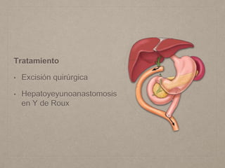 Tratamiento
• Excisión quirúrgica
• Hepatoyeyunoanastomosis
en Y de Roux
 