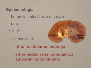 Epidemiología
• herencia autosómica recesiva
• rara
• ♀=♂
• se asocia a:
• riñón medular en esponja
• enfermedad renal poliquística
autosómica dominante
 