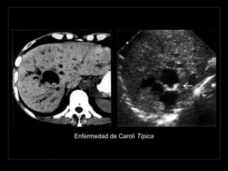 Enfermedad de Caroli Típica
 