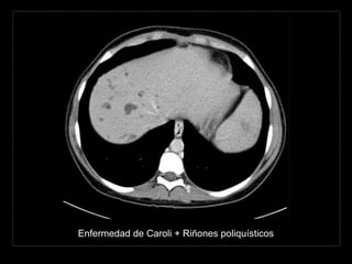Enfermedad de Caroli + Riñones poliquísticos
 