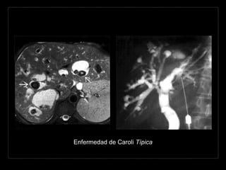 Enfermedad de Caroli Típica
 