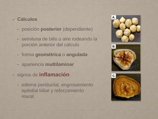 • Cálculos
• posición posterior (dependiente)
• semiluna de bilis o aire rodeando la
porción anterior del cálculo
• forma geométrica o angulada
• apariencia multilaminar
• signos de inflamación
• edema periductal, engrosamiento
epitelial biliar y reforzamiento
mural.
 