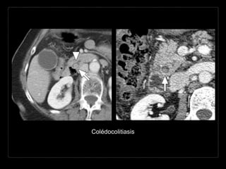 Colédocolitiasis
 