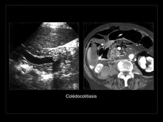 Colédocolitiasis
 