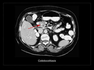 Colédocolitiasis
 
