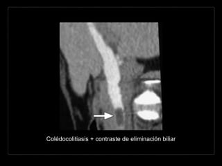 Colédocolitiasis + contraste de eliminación biliar
 