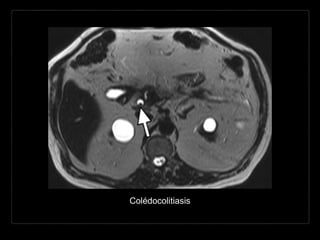 Colédocolitiasis
 