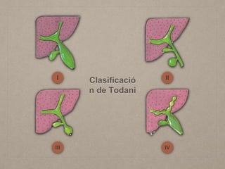 Clasificació
n de Todani
I II
III IV
 