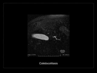 Colédocolitiasis
 