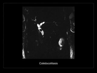 Colédocolitiasis
 