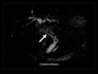 Colédocolitiasis
 