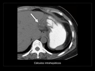 Cálculos intrahepáticos
 