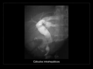 Cálculos intrahepáticos
 