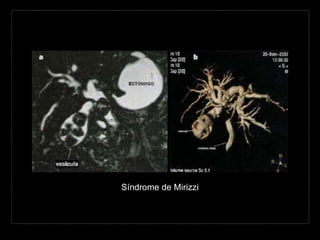 Síndrome de Mirizzi
 