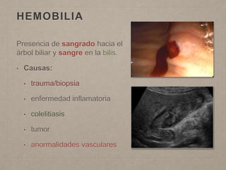 HEMOBILIA
Presencia de sangrado hacia el
árbol biliar y sangre en la bilis.
• Causas:
• trauma/biopsia
• enfermedad inflamatoria
• colelitiasis
• tumor
• anormalidades vasculares
 