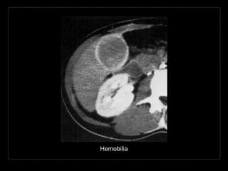 Hemobilia
 