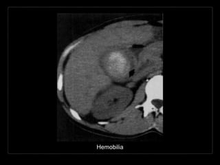 Hemobilia
 