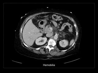 Hemobilia
 