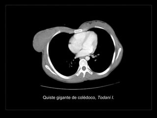 Quiste gigante de colédoco, Todani I.
 